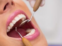 Dentysta egzamininuje zenskich cierpliwych zeby 215x161