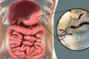 Helicobacter pylori – bakteria czy mit 130x86
