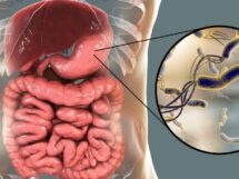 Helicobacter pylori – bakteria czy mit 215x161
