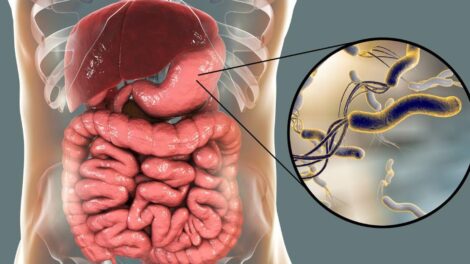 Helicobacter pylori – bakteria czy mit 470x264