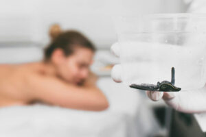 Hirudoterapia leczenie migreny 300x200