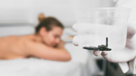 Hirudoterapia leczenie migreny 470x264