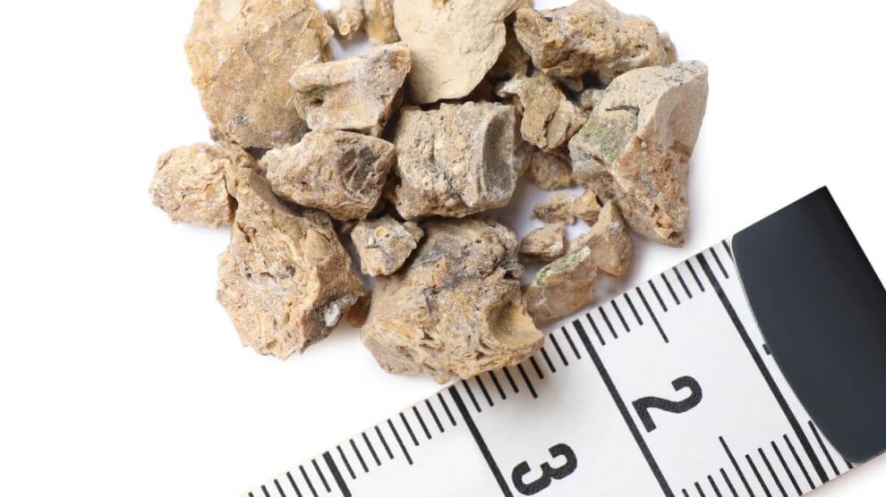 Kamica nerkowa 990x556