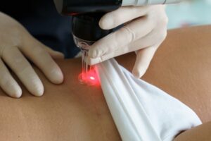 Leczenie blizn M 300x200