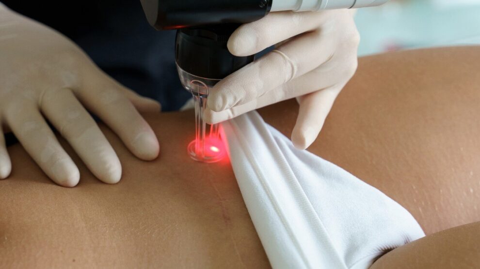 Leczenie blizn M 990x556