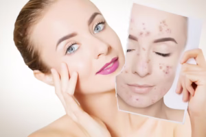 jak usunąć przebarwienia na twarzy