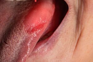 Zapalenie jezyka 300x200
