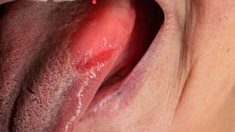 Zapalenie jezyka 470x264