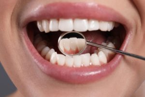 Nowotwory jamy ustnej 300x200
