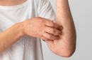 Skin allergy reaction person s arm 130x86