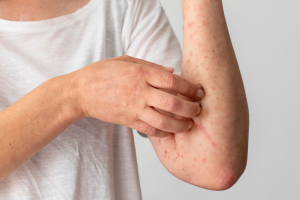 Skin allergy reaction person s arm 300x200