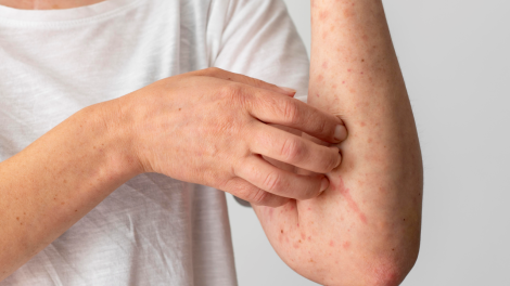Skin allergy reaction person s arm 470x264