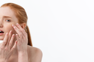 Young caucsian woman squeezes acne face beauty 300x200