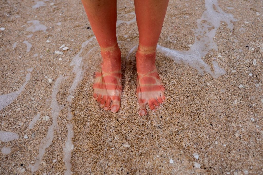 View woman s sunburn feet from wearing sandals beach 1024x682