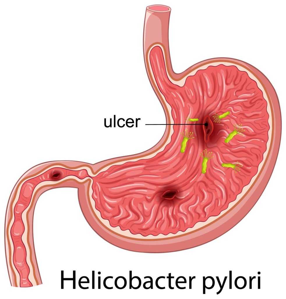 Helicobacter 982x1024