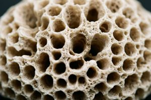 Osteoporoza nie boli. Jak rozpoznać, że kości potrzebują uwagi, zanim dojdzie do złamania?